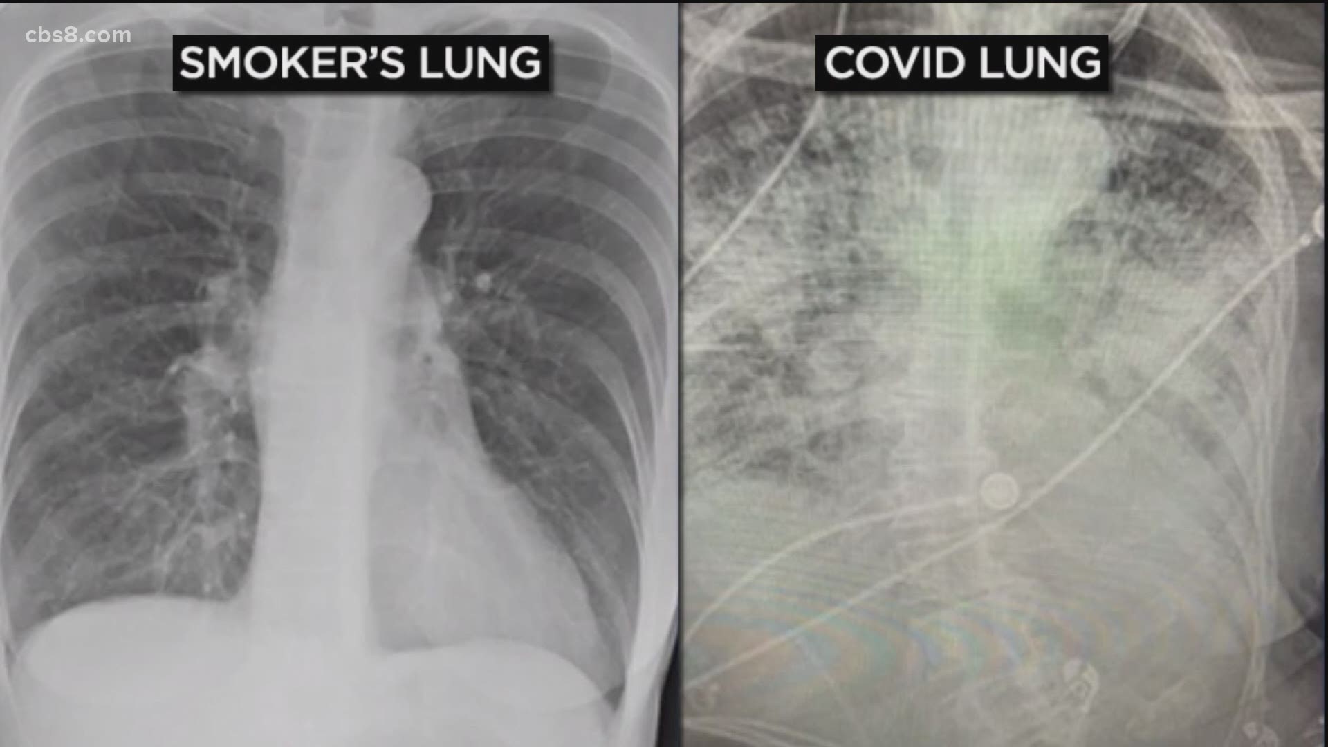 A pulmonary critical care doctor breaks down how lung damage of recovering COVID-19 patients compares to lung damage from habitual smoking.