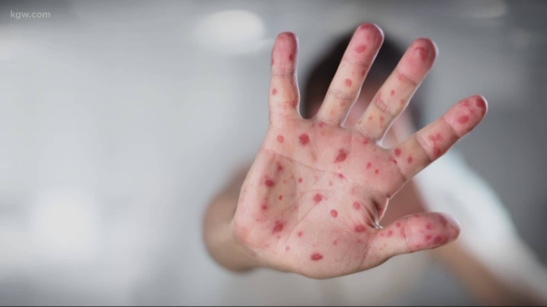 The Clark County measles outbreak is officially over.