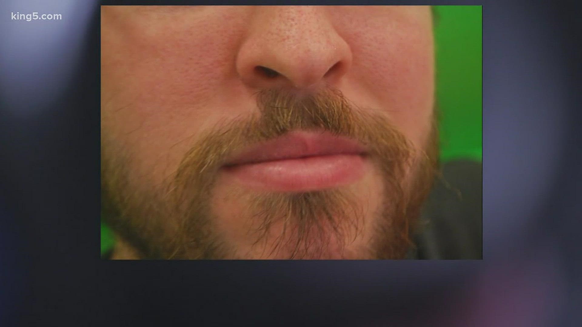 Facial hair transplants fill in spotty beards | king5.com
