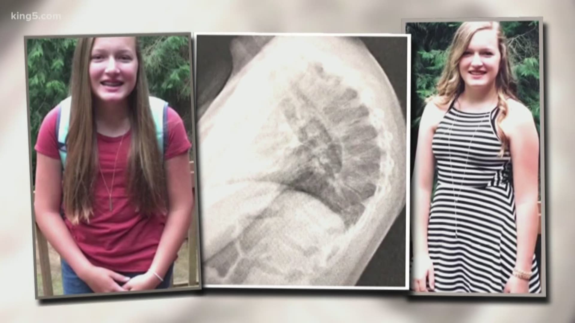 A teen in Covington decided to make a video of her battle with Kyphosis. A spinal disorder that gives an excessive curve in the upper back. KING 5's Morgan Brice has the story.