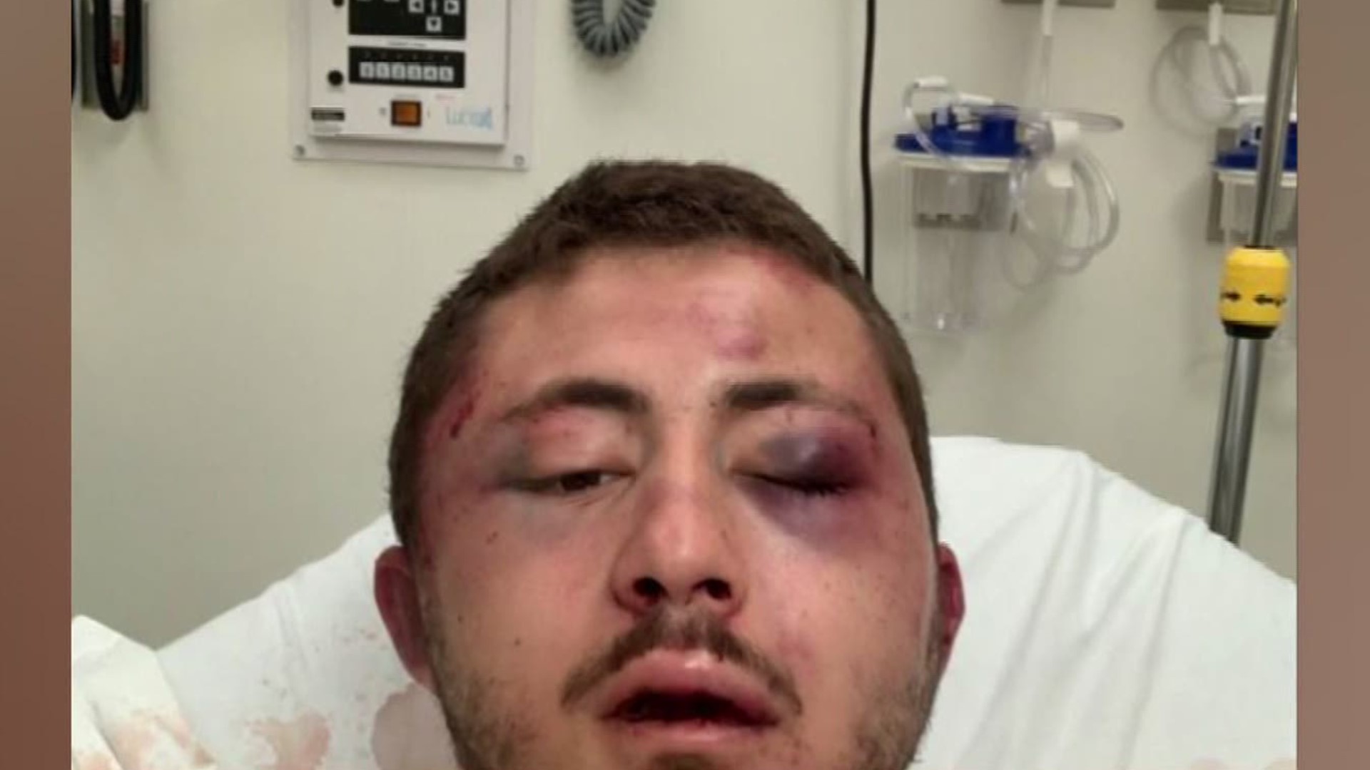 He suffered a concussion, a broken nose and bleeding. His coworkers helped pull the attacker off him and created a GoFundMe for his hospital expenses.