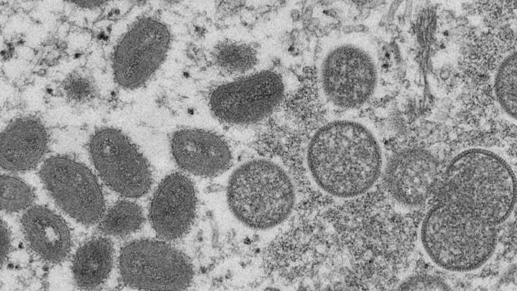 Presumptive case of the monkeypox virus investigated in King County