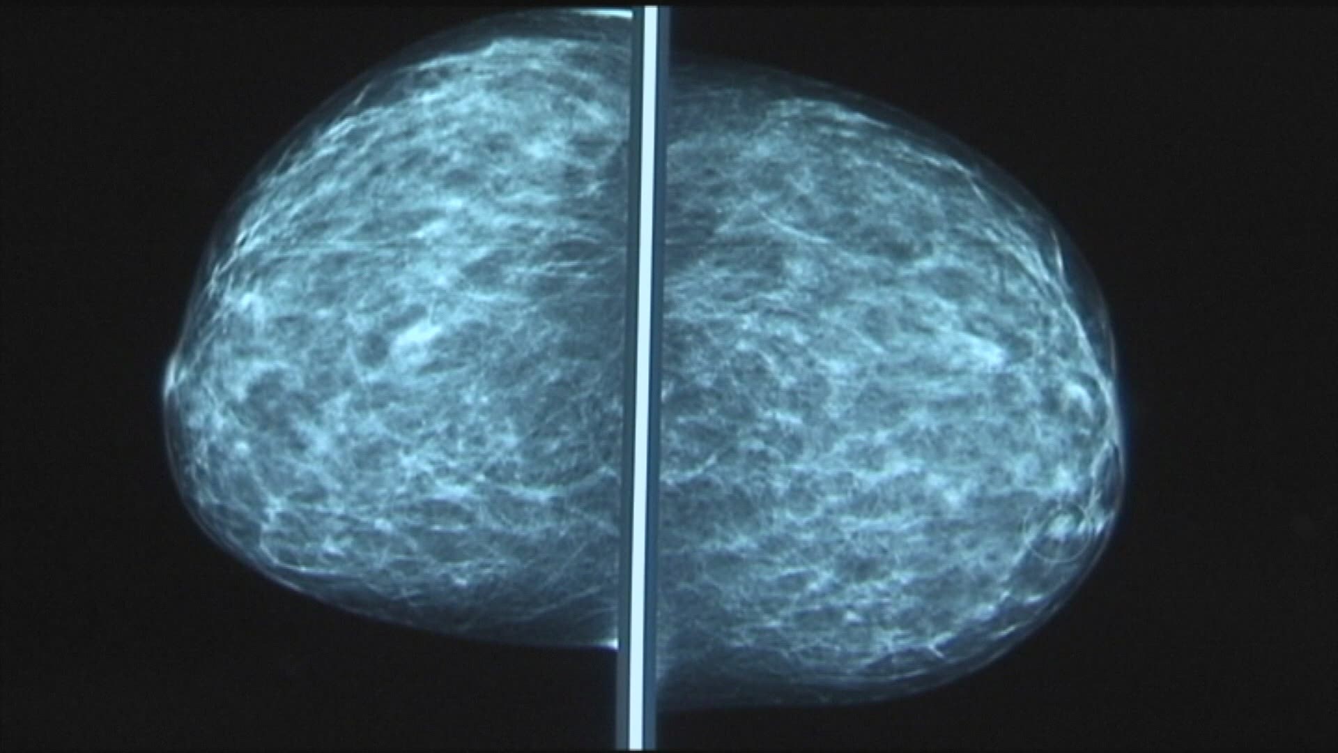 Breast cancer screenings fell by 58% during the pandemic. A breast cancer survivor is warning others to reschedule their missed screenings.