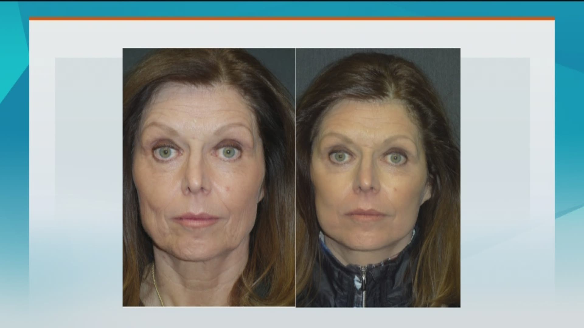 Facial Plastic Surgery Blog - Facial Rejuvenation Procedures