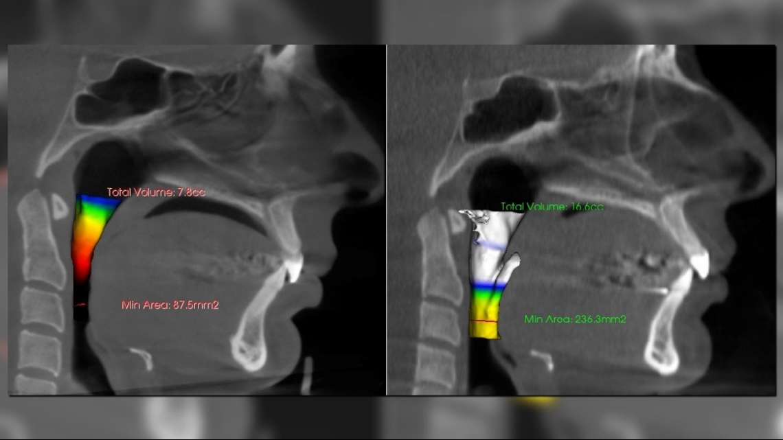 Can orthodontics help rid you of migraines?