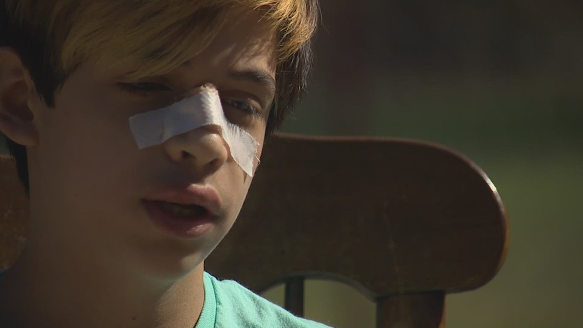 Frontier Middle School student beaten by classmate required facial reconstruction surgery