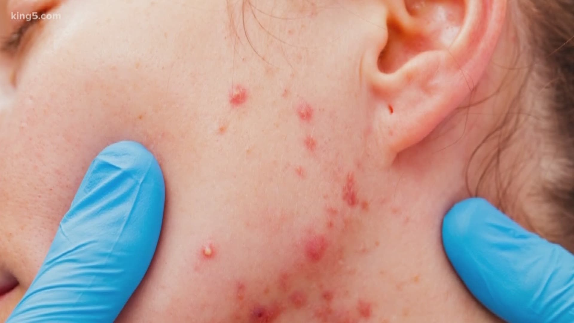 Health officials expect the current measles outbreak will continue to grow over the coming weeks and months.