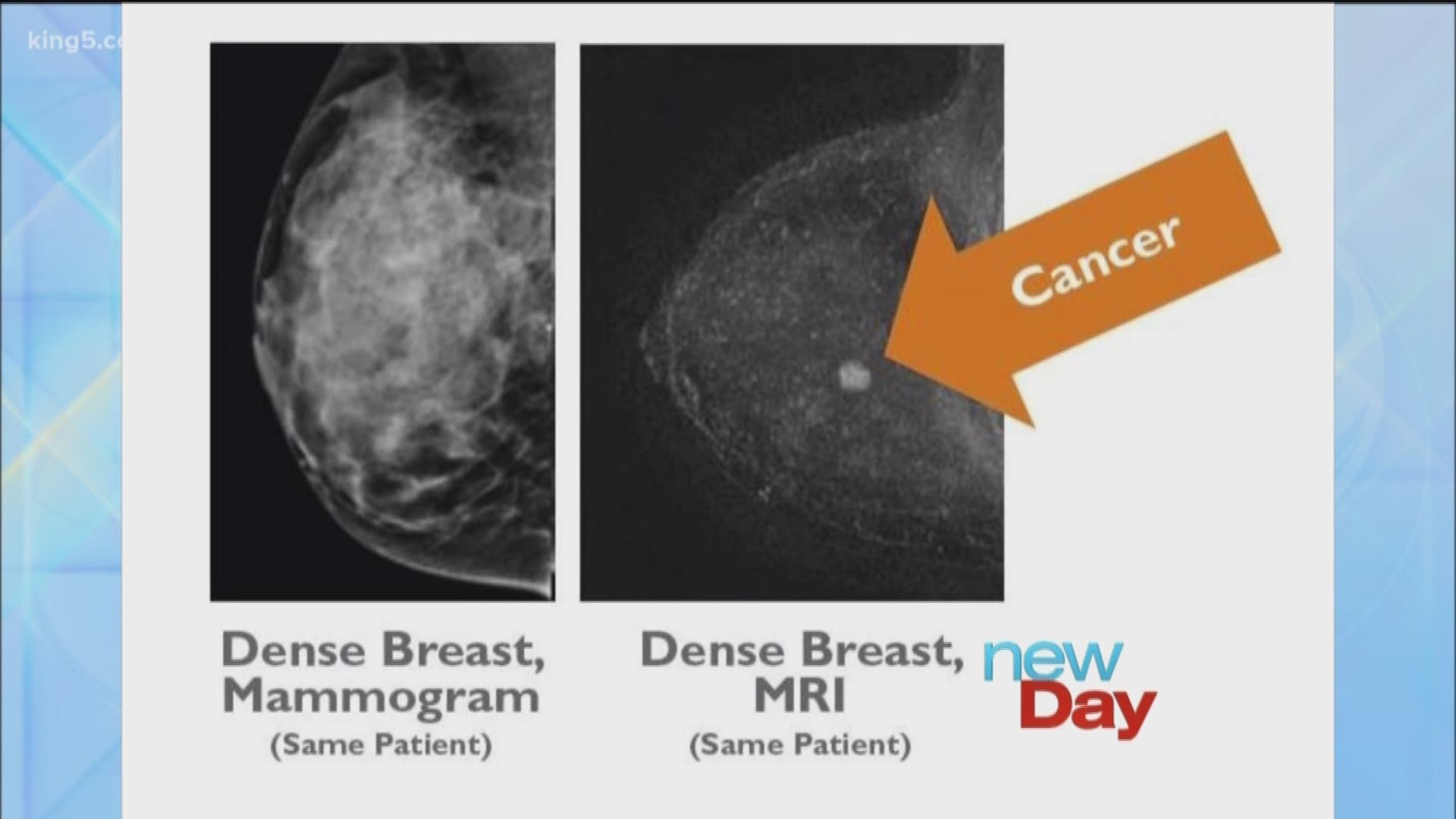 what-is-breast-density-why-does-it-matter-king5