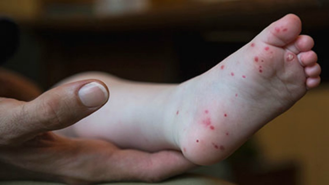 Small outbreak of contagious hand, foot, and mouth disease at ...