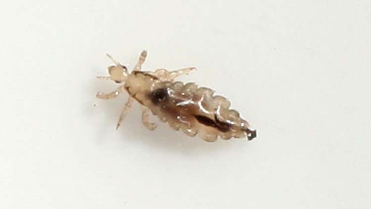 Here's how to treat head lice on your kids | king5.com