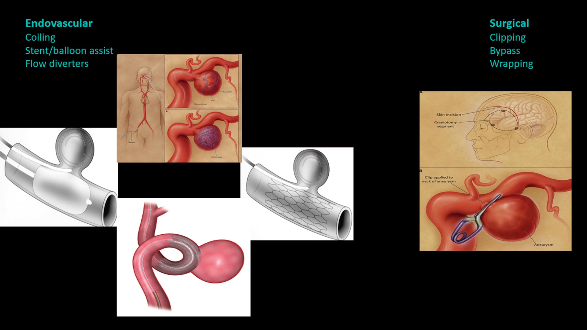 brain-aneurysms-and-their-treatment-with-or-without-surgery-king5