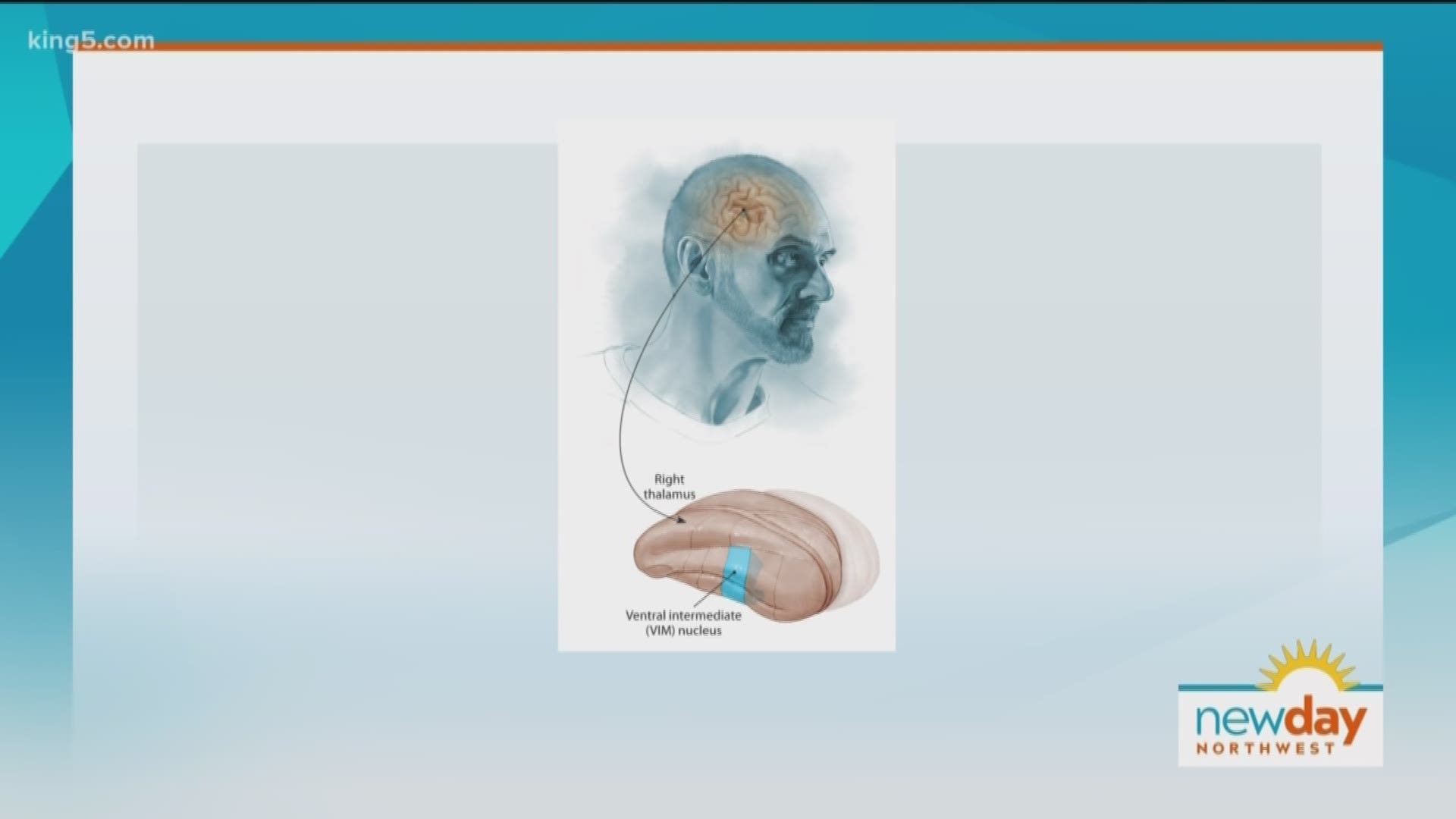 Swedish is the first center in the Pacific Northwest to offer focused ultrasound ablation to patients with essential tremor. This segment is sponsored by Swedish.