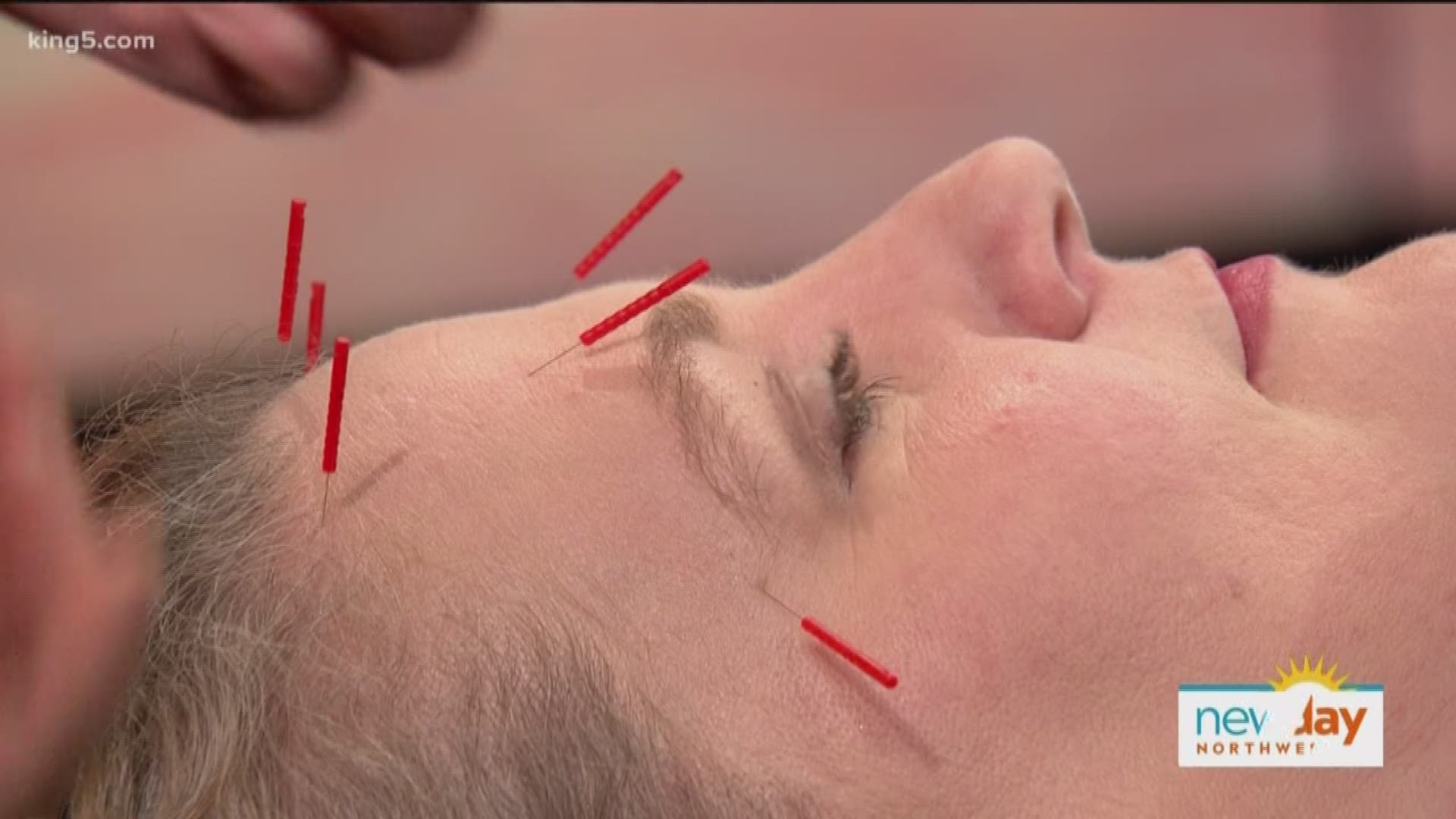Modern Acupuncture offers cosmetic services that can help reduce the signs of aging in an exciting new way.