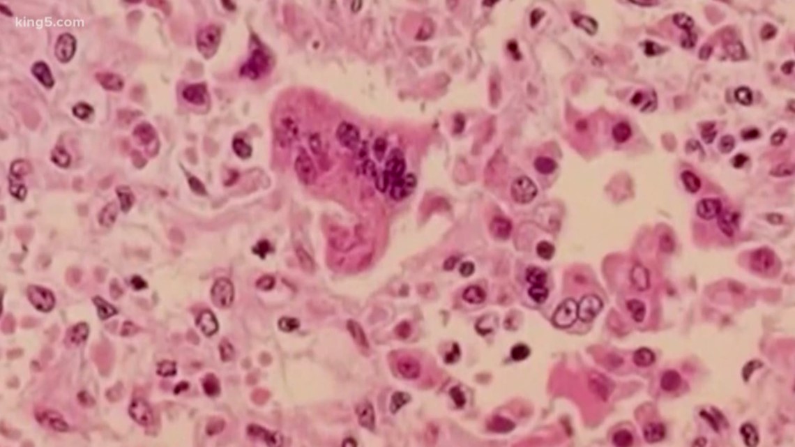 Seattle school moves to remote learning due to measles case