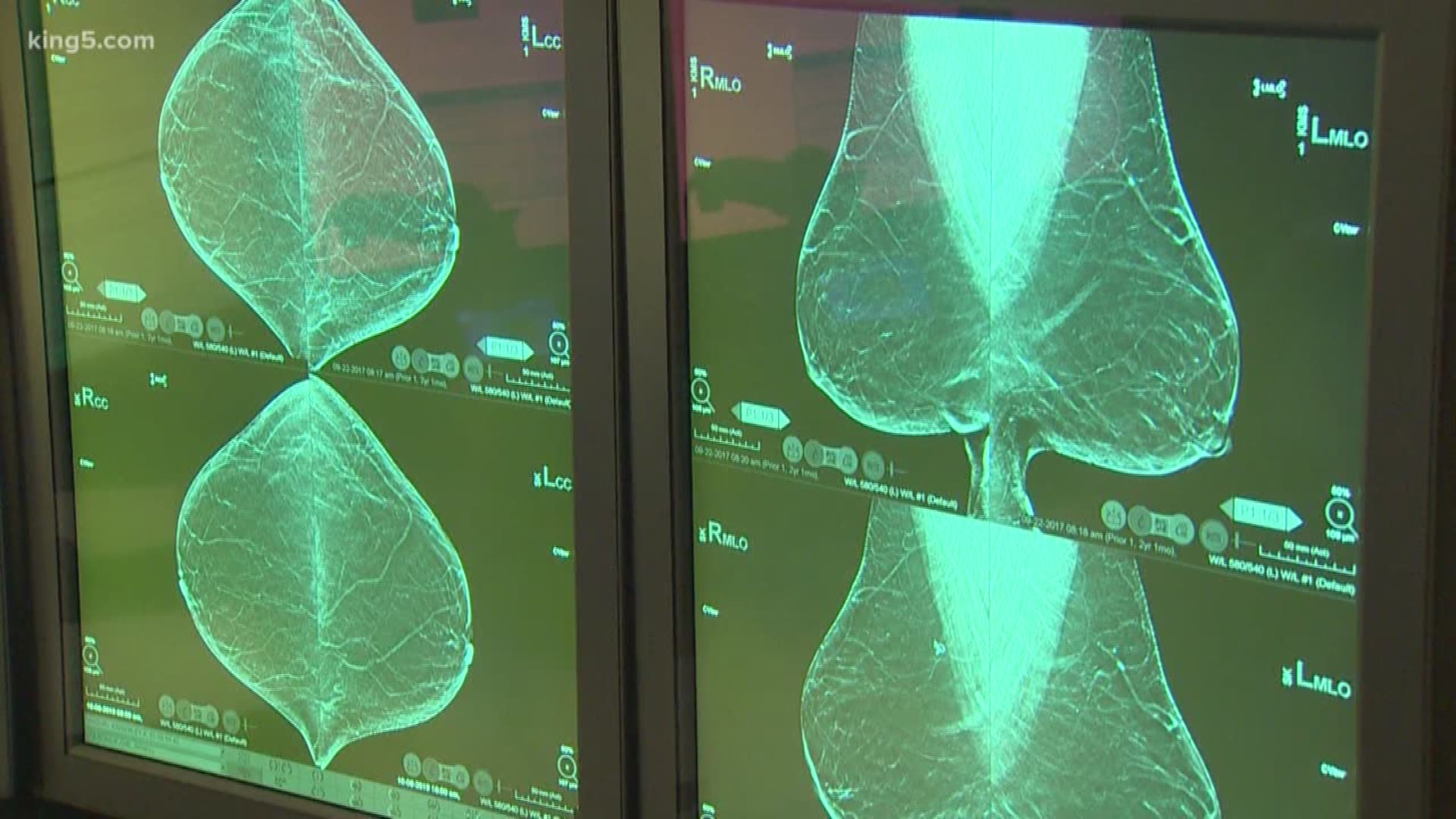 Mimi Jung looks at how 3D mammograms are giving doctors a more accurate way to detect breast cancer.