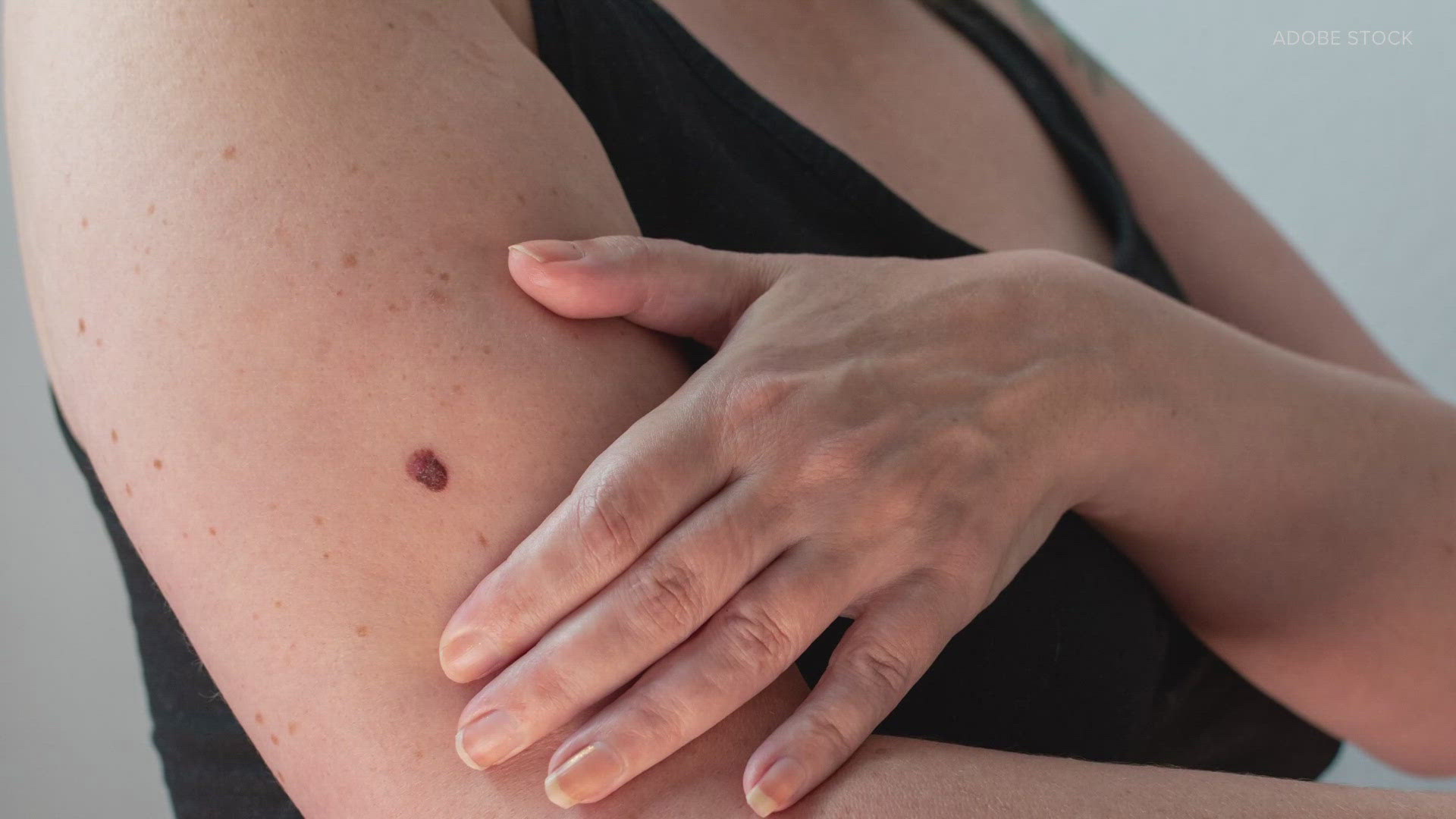 What type of mole is suspicious? Is a little bit of sun exposure OK? What about vitamin D absorption? A Fred Hutch dermatologist weighs in.