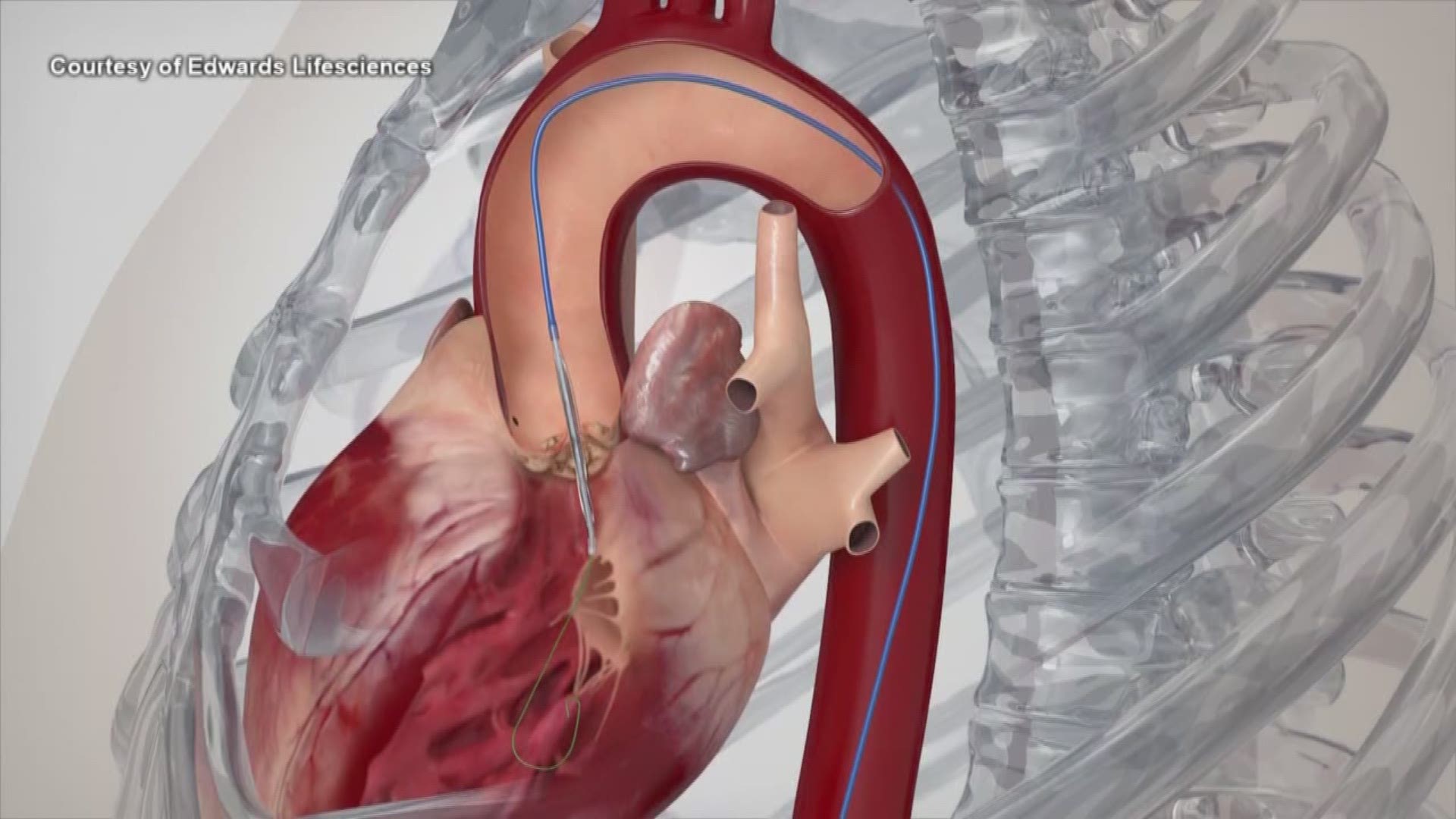 Noninvasive heart valve replacement procedure under UW