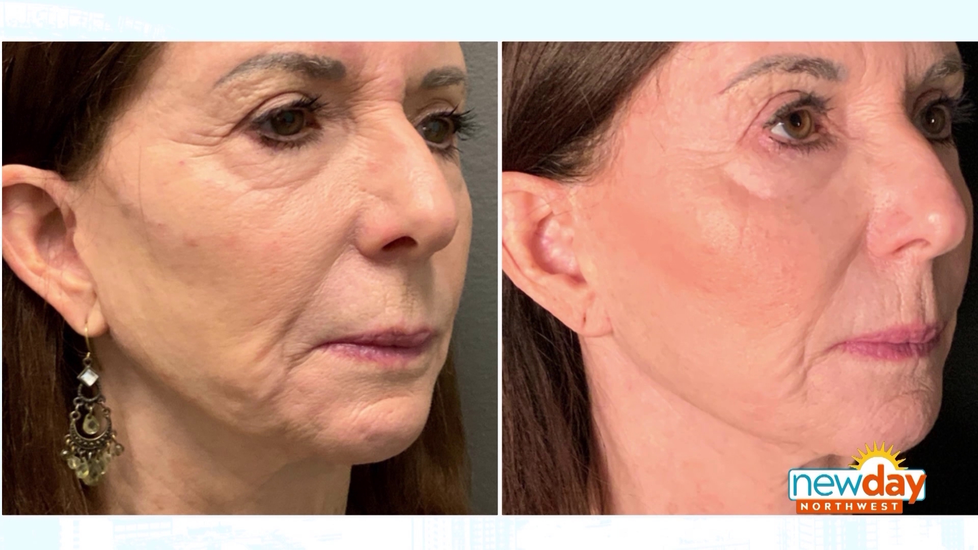 Nonsurgical Skin‑Tightening Options to help skin health as you age