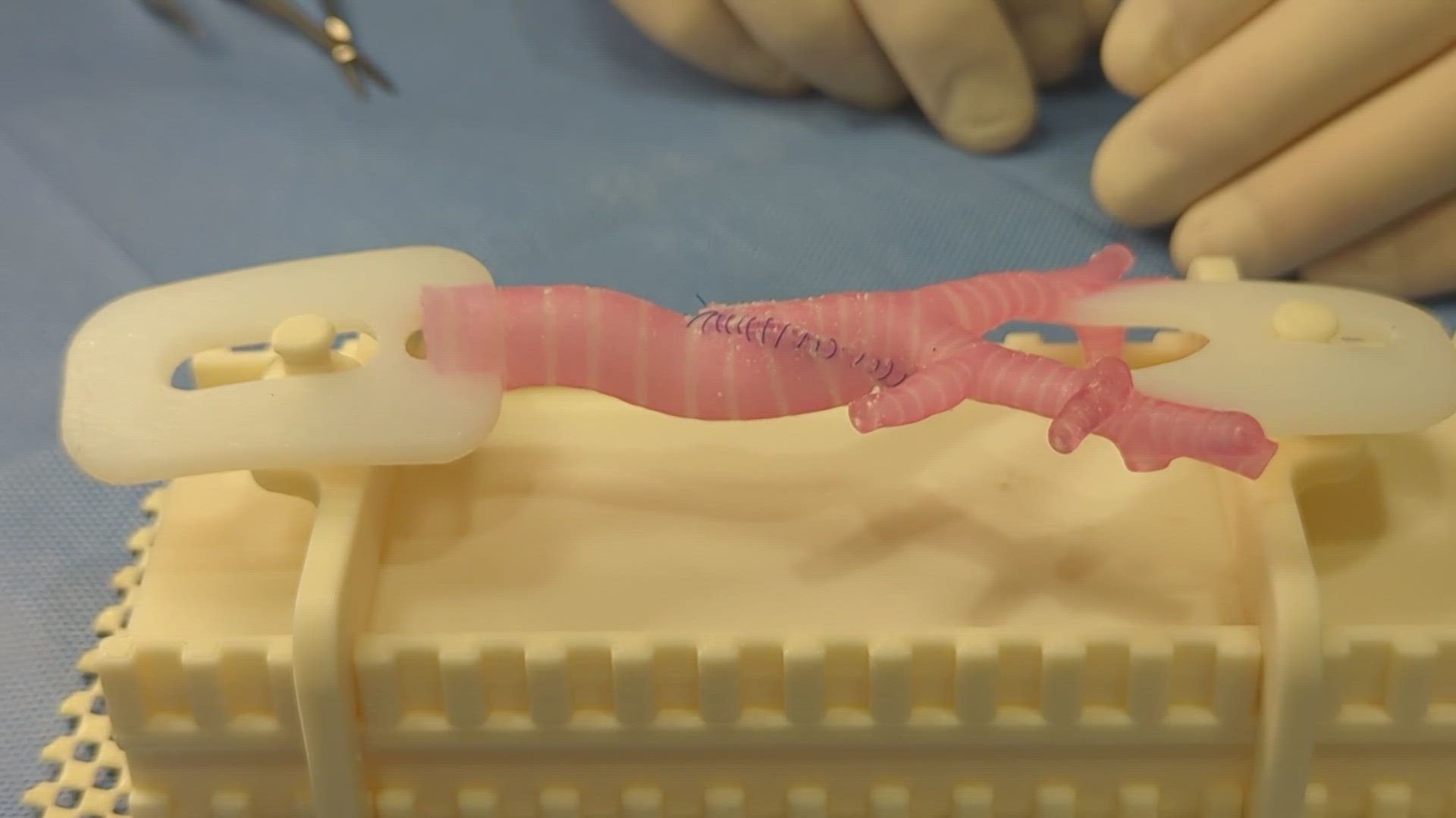 Seattle Children's Innovation Lab prints 3D models of children's trachea to use for surgery training