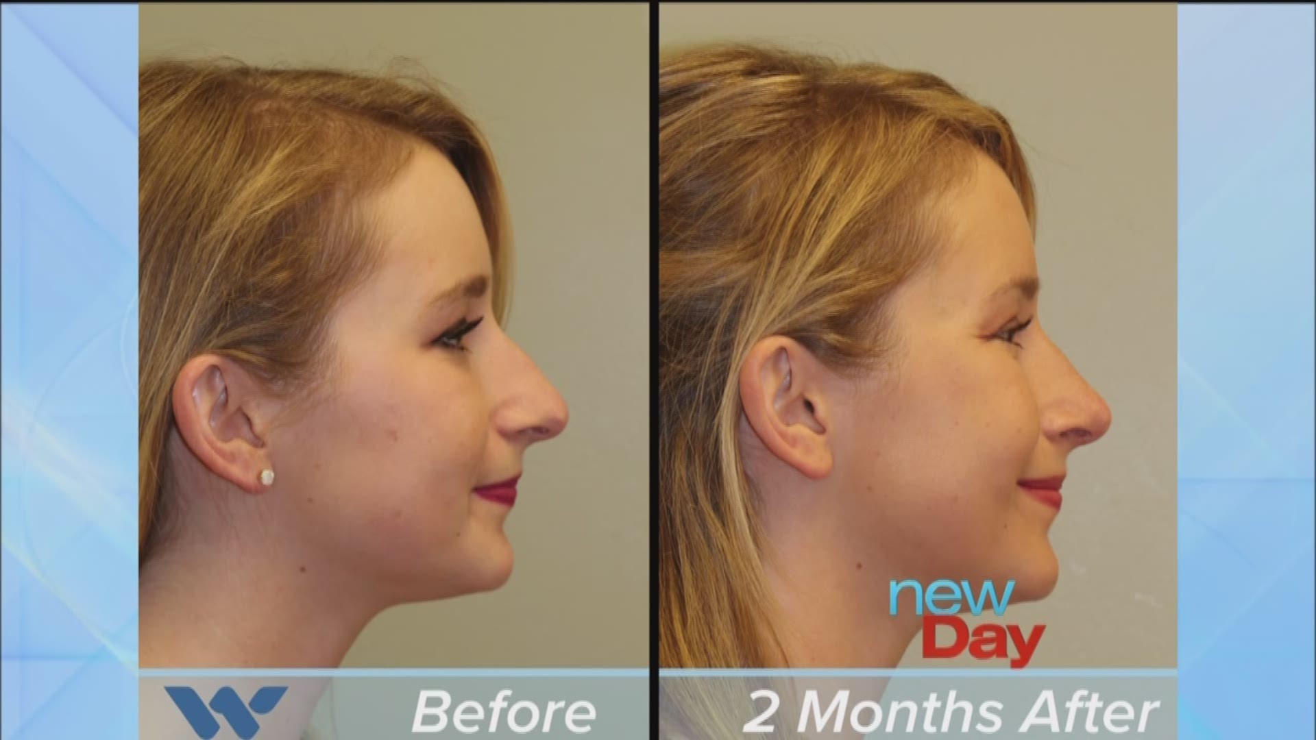 Rhinoplasty Seattle - Rhinoplasty Specialist - Bellevue Rhinoplasty