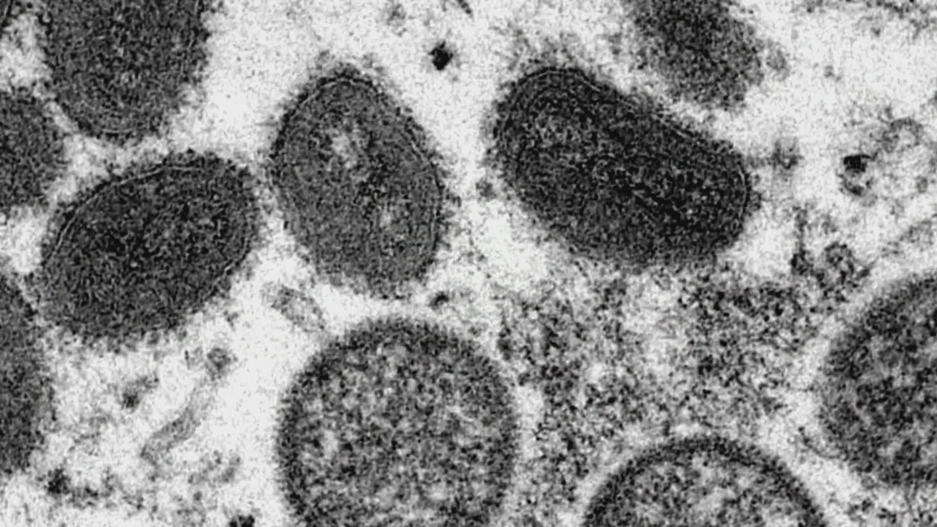 A monkeypox case was confirmed in a 17-year-old in Washington state. The Department of Health declined to specify the county for privacy reasons.