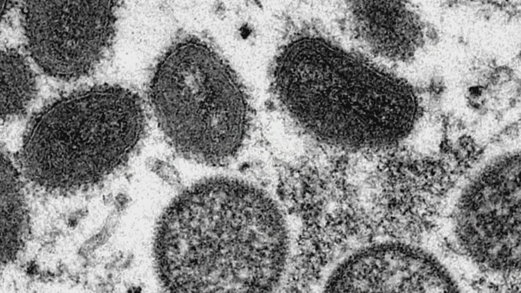 Washington reports first pediatric monkeypox case
