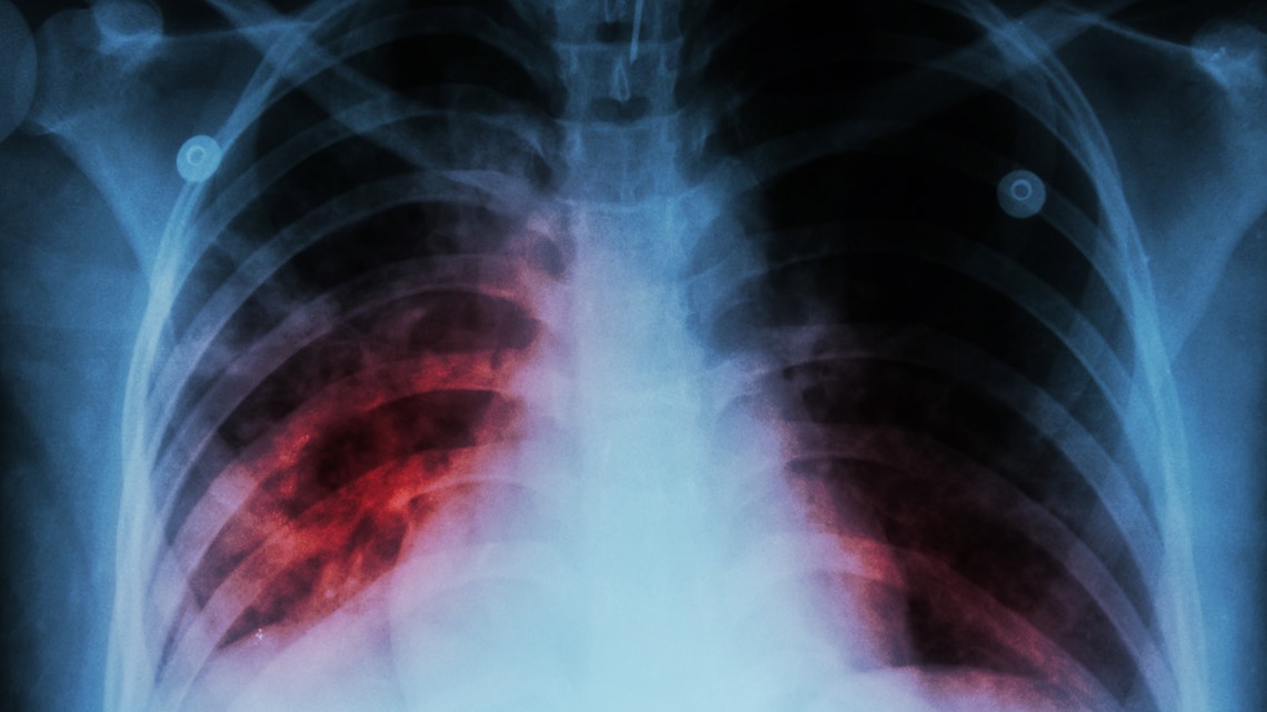 Washington experiencing largest tuberculosis outbreak in 20 years