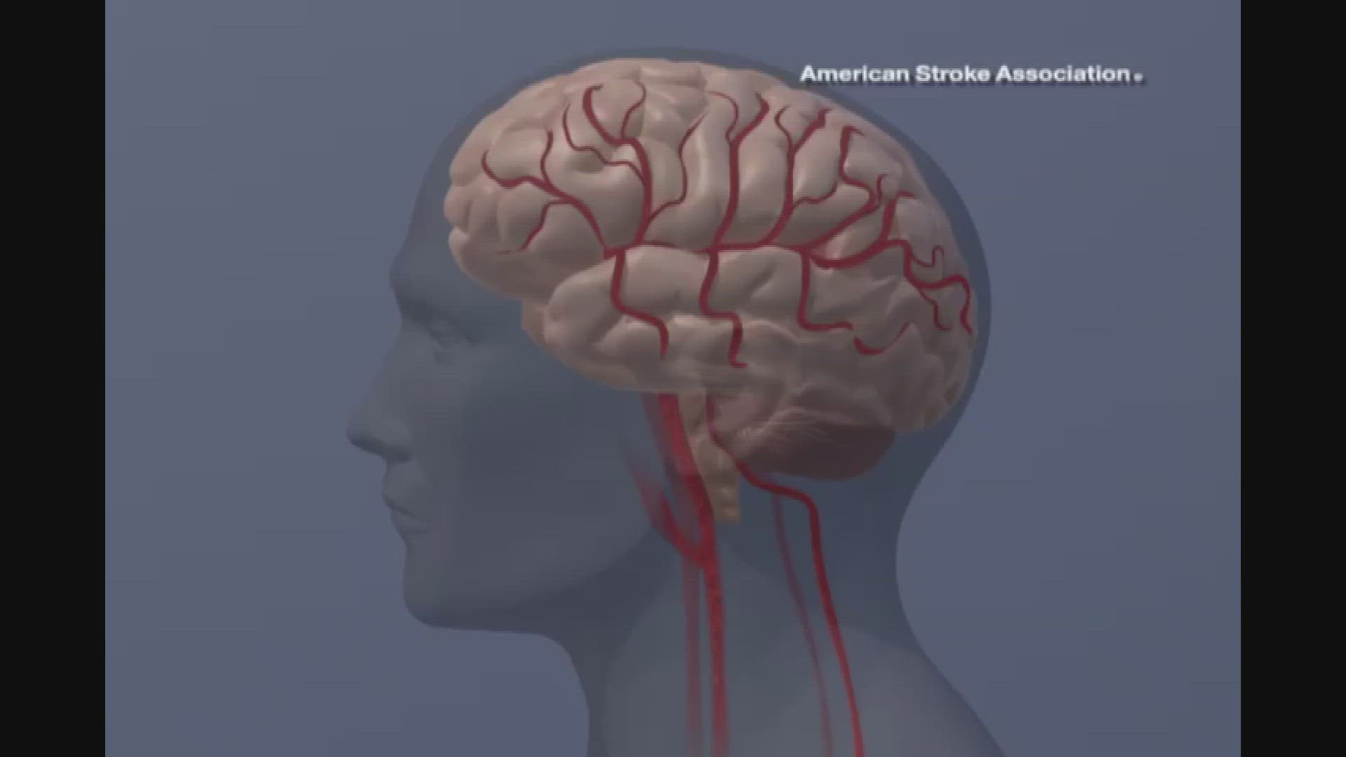 Nearly 800,000 cases of stroke happen every year in the United States.