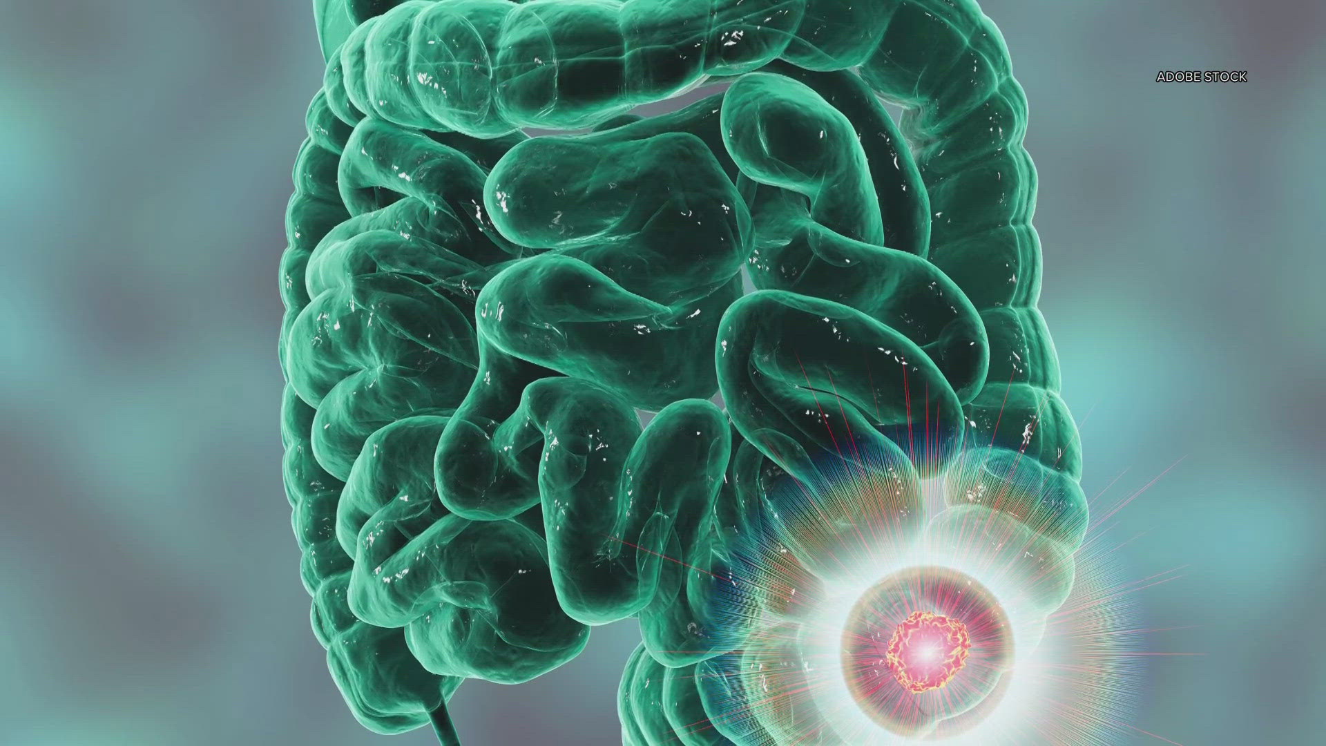 More young people being diagnosed with colorectal cancer: HealthLink ...