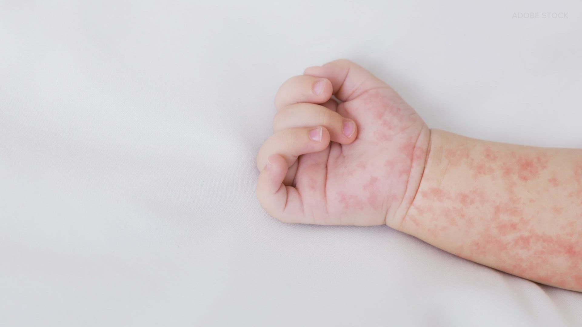 HealthLink talks with state public health officials about childhood immunization rates in WA amid a concerning rise in measles cases in the U.S.