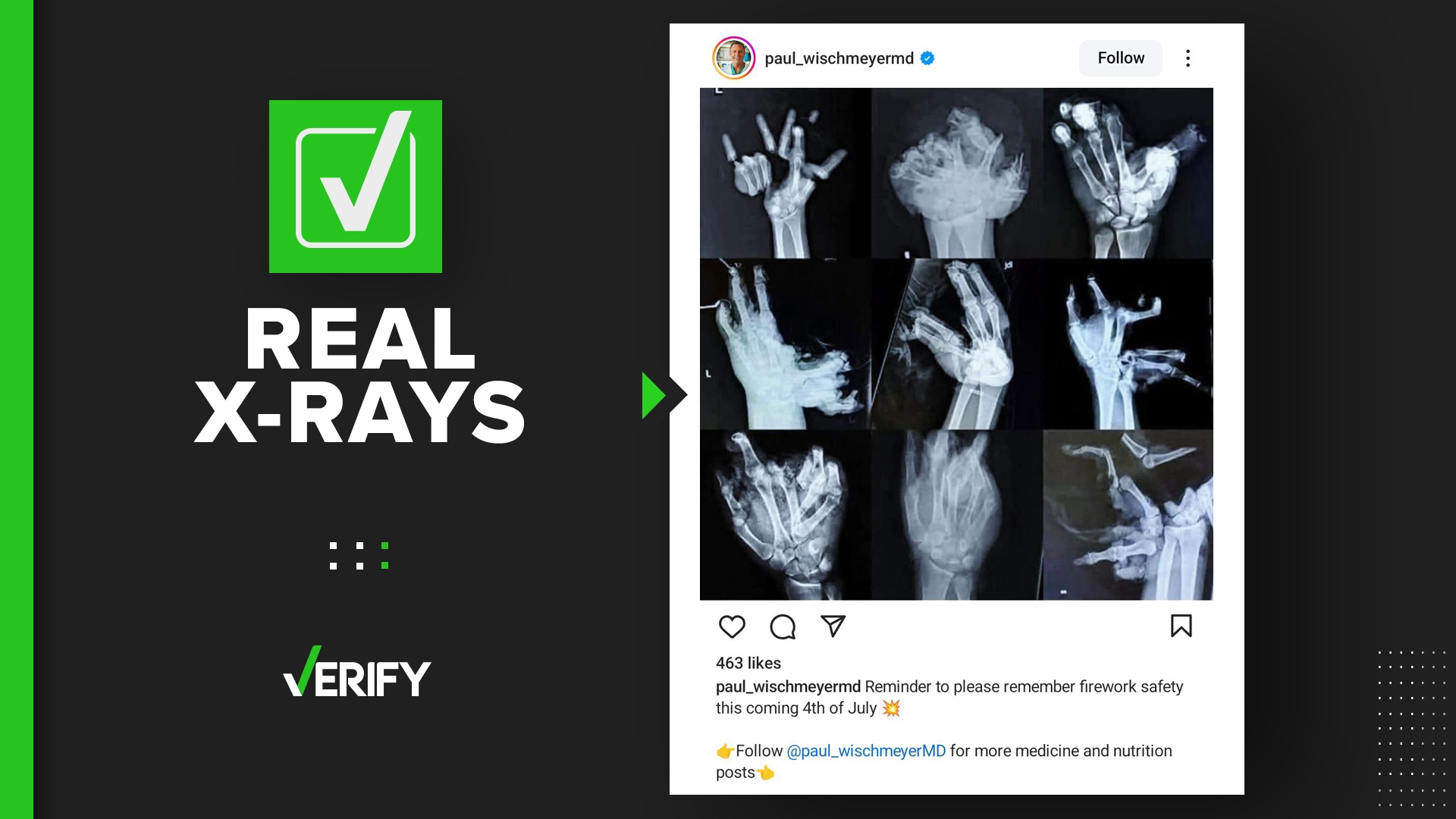 Hand X-ray Photo Shows What Real Firework Hand Injuries Look Like 