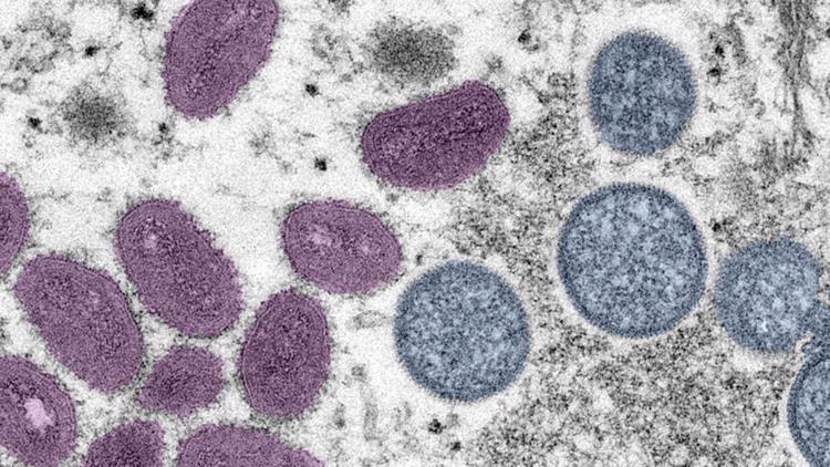 Washington reports first pediatric monkeypox case