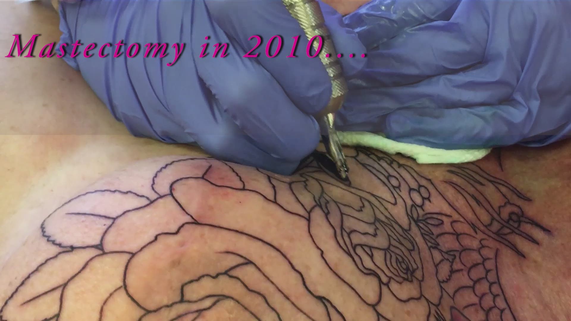 Tattoo Removal: Excision - The Cosmetic and Skin Surgery Center